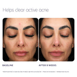 PCA Acne Control Prebiotic Gel Cleanser